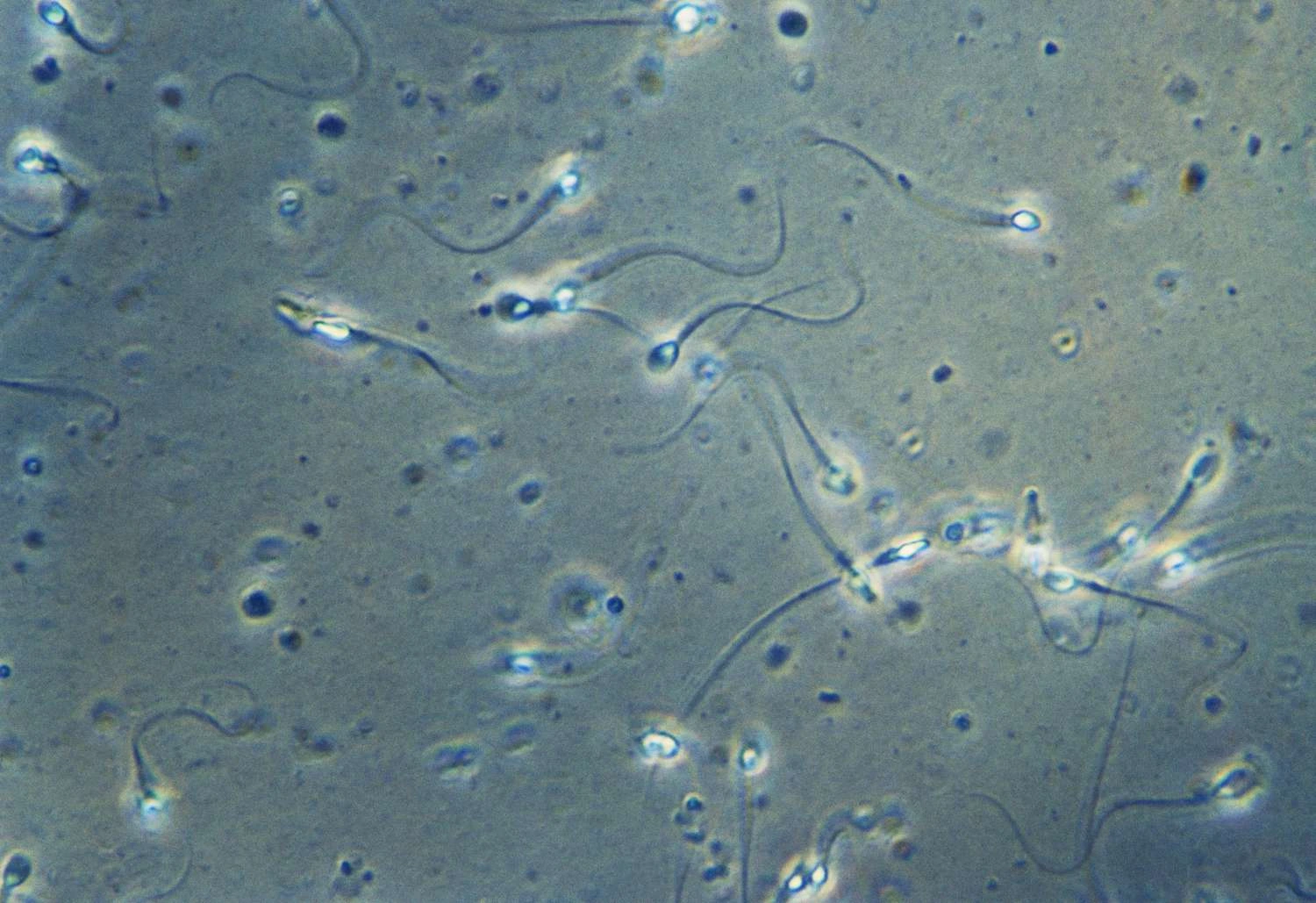 Genix Fertility Care | Best Infertility Treatment in Bhubaneswar, Odisha >> Male factor subfertility such as low sperm count and motility